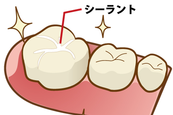 シーラント