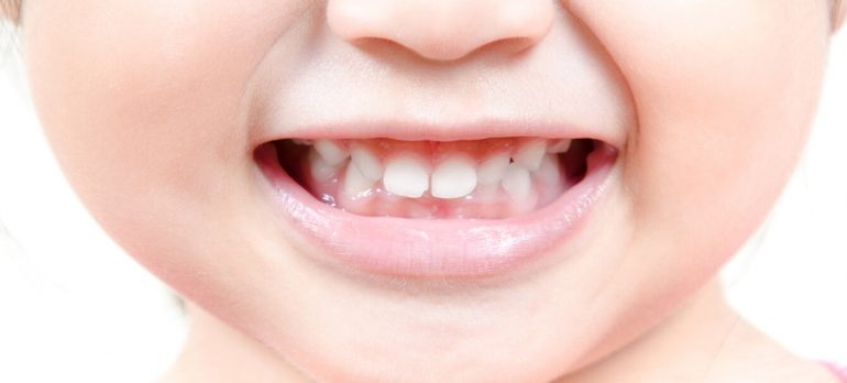 子どもの矯正治療