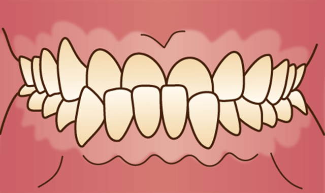双方交叉咬合