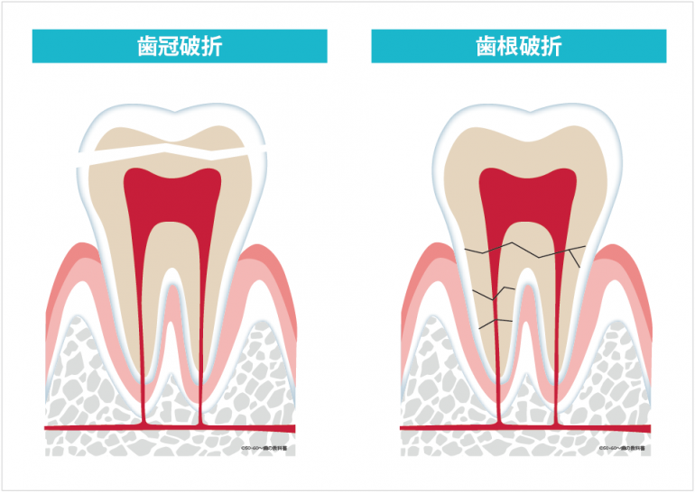 歯牙破折は抜歯の三大原因